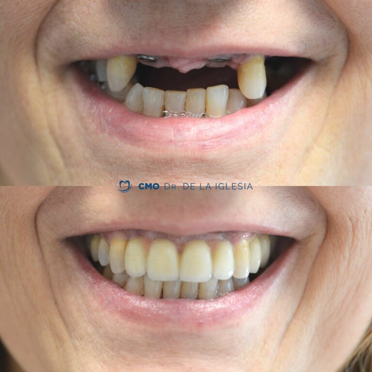 antes y después