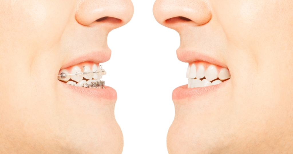 Ortodoncia vs brackets metálicos